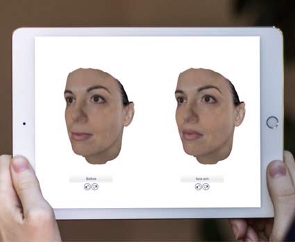 3D Simulation Lippenvergrößerung Vorher-Nachher