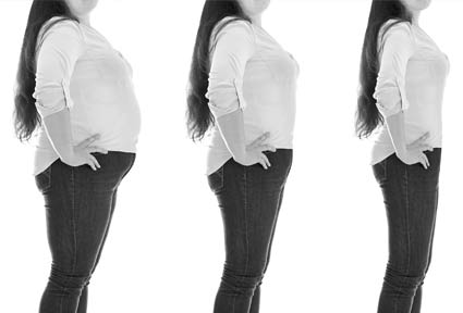 Übergewichtige Frau vor und nach Gewichtsreduktion