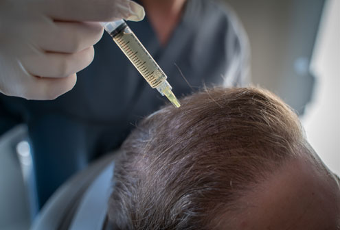 Testimonial erhält im Zuge der Haarbehandlung Spritzen in die Kopfhaut