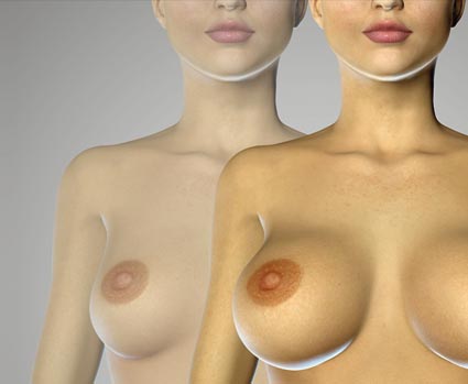 Brustvergrößerung 3D simuliert