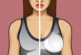 Illustration einer Frau mit einer natürlichen und einer sichtbar gemachten Brust