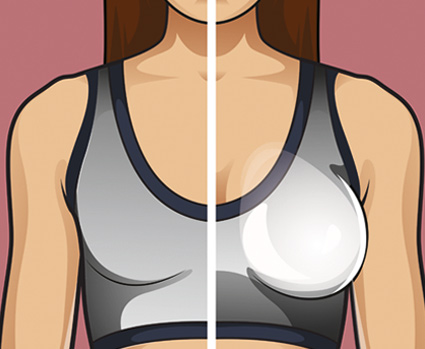 Illustration einer Frau mit einer natürlichen und einer sichtbar gemachten Brust