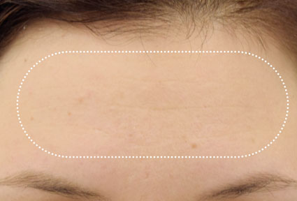 Nahaufnahme der Stirn einer Patientin nach der Behandlung mit EMFACE® 
