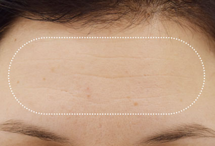 Nahaufnahme der Stirn einer Patientin vor der Behandlung mit EMFACE® 