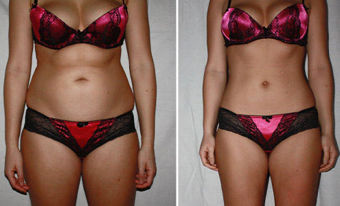 vor und nach der Fettabsaugung am Bauch