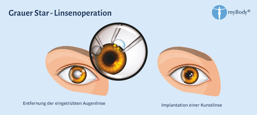 Linsenchirurgie Methoden berblick ber Moderne Methoden Der Linsenchirurgie Methoden berblick ber Moderne Methoden Der