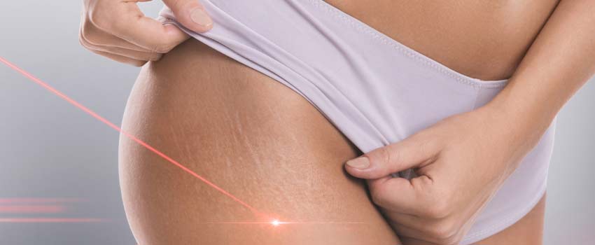 Laserbehandlung bei Cellulite