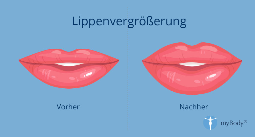 Skizze einer Lippenvergrößerung vorher und nachher