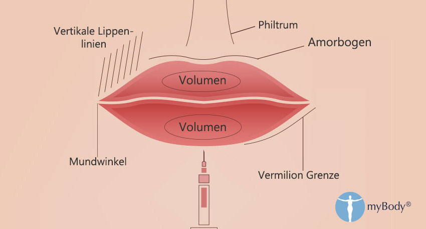 Lippenvergrößerung Methoden 