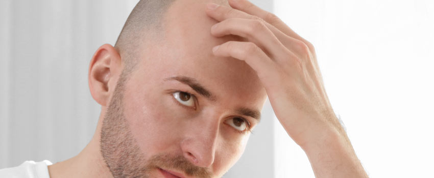 Mann mit Haarausfall