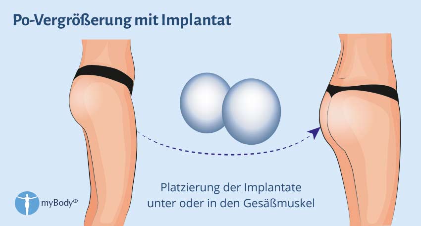 Illustration Methode Po-Vergrößerung mit Implantat