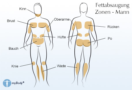 Fettabsaugung: Mögliche Behandlungszonen bei dem Mann