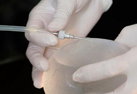 SEBBIN Implantate Herstellung Befüllen des Implantats