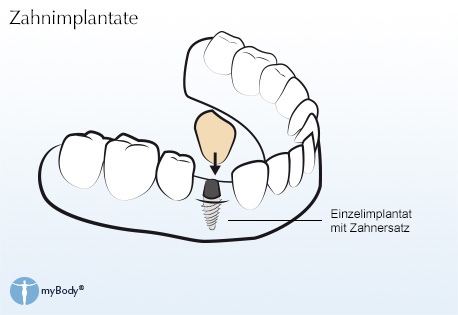 Typische Zahnimplantat-Versorgungen