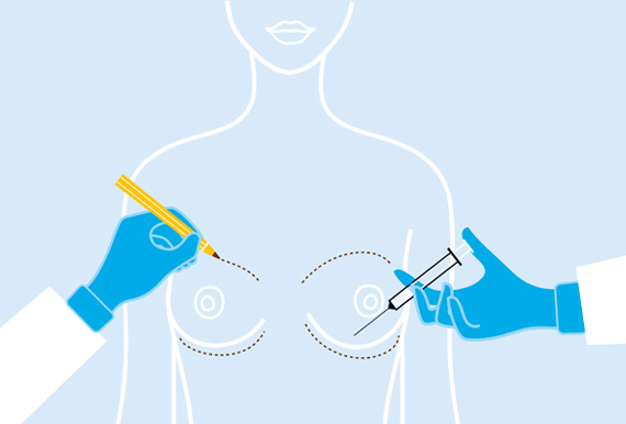 Illustration einer Brustvergrößerung mit Skalpell und Spritze