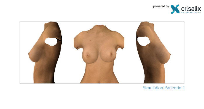 Brust-OP in 3D mit 200 ml Brustimplantat