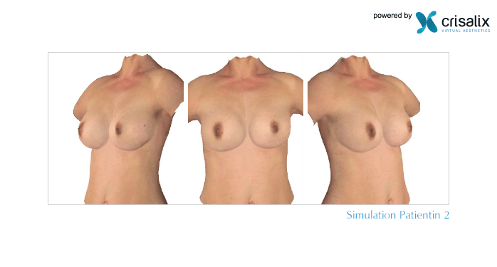 Patientin 2: Brustvergrößerung in 3D mit 310 ml Brustimplantat