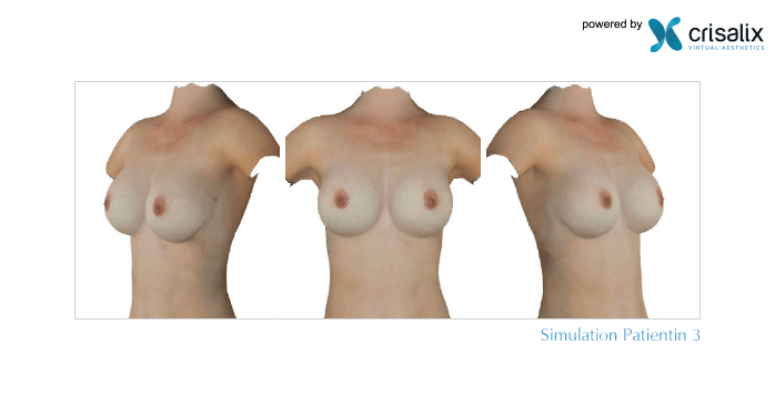 Patientin 3: Brustvergrösserung in 3D mit 425 ml Brustimplantat