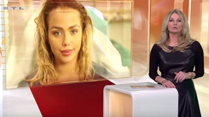 Kim Gloss ließ sich von RTL bei ihrer Haar-OP begleiten