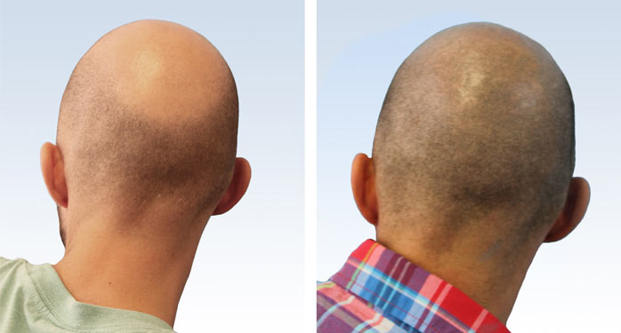 Vorher-Nachher Micro Hair-Behandlung - Hinterkopf