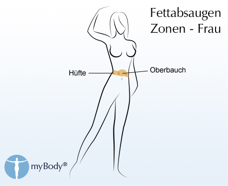Skizze - Fettabsaugen an Hüfte und Bauch Zonen